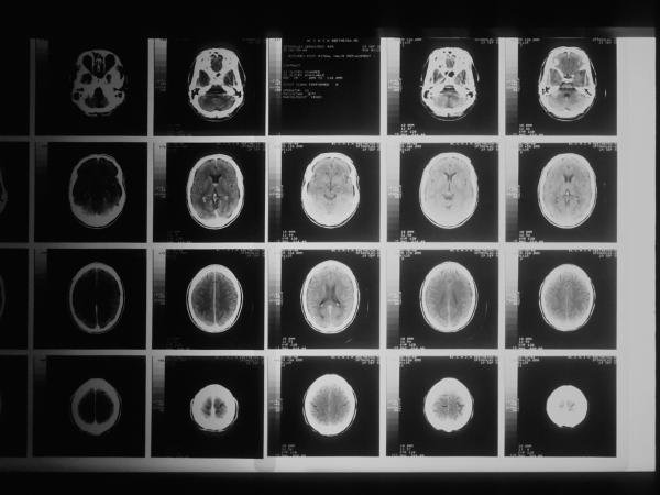 Brain tumour in children - U-R-Immune Glioma trial by Anticancer Fund